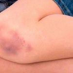 4 ways to draw a bruise