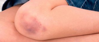 4 ways to draw a bruise