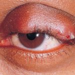 Upper eyelid abscess before medical care