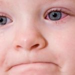 Allergic conjunctivitis in children