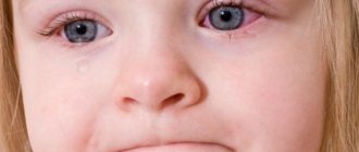 Allergic conjunctivitis in children