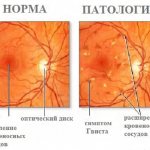 Retinal angiopathy