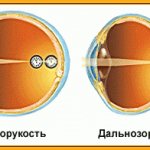 Анизометропия