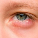 Blepharitis. Treatment, drops, ointments for adults, children 