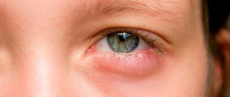 Blepharitis. Treatment, drops, ointments for adults, children 