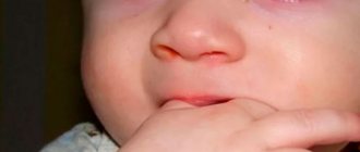 Blepharitis in children