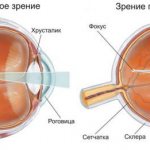 nearsightedness or myopia