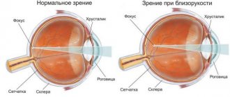 nearsightedness or myopia