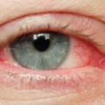 Болезнь глаукома