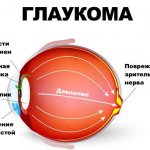 What is glaucoma