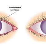 Что такое помутнение хрусталика глаза