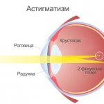 What is mixed astigmatism in both eyes?