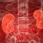 What does microurolithiasis of the left, right or both kidneys mean?