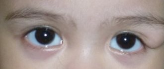 Causes of dermoid cyst on eyelid