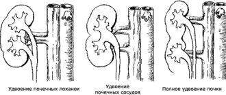 double kidney