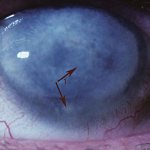 Эпителиальная передняя дистрофия глаза человека