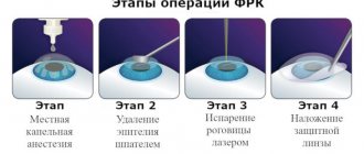 Stages of eye surgery using the PRK method