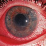 Photo of iridocyclitis with redness of the corneal vessels
