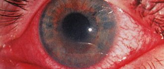 Photo of iridocyclitis with redness of the corneal vessels