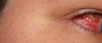 photo of eye conjunctivitis