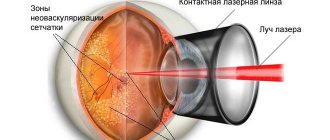 Hemophthalmos of the eye