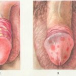 Genital itching in men