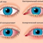 Eye drops with a broad-spectrum antibiotic. List for children, adults 