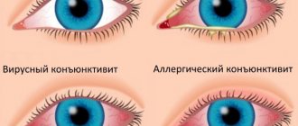 Eye drops with a broad-spectrum antibiotic. List for children, adults 