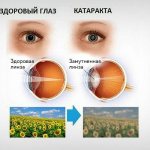 How does a person see with cataracts?