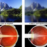 How does a person with early cataracts see?