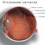What does a retinal detachment look like inside the eye?