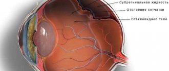 What does a retinal detachment look like inside the eye?