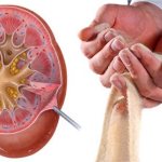 How sand comes out of the kidneys: symptoms in women and men