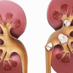 Stones in the kidneys