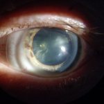 катаракта глаза