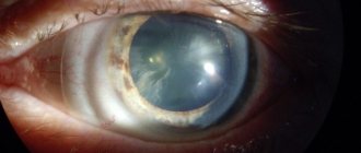 eye cataract