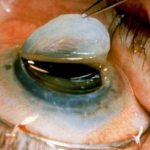 Keratoplasty - corneal transplant