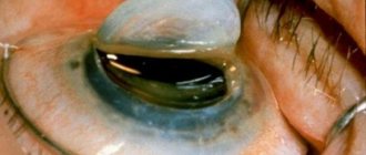 Keratoplasty - corneal transplant
