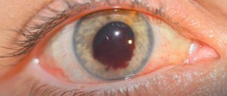 hemorrhage in the anterior chamber of the eye