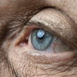 Макулодистрофия сетчатки глаза у пожилого человека