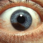 Choroidal melanoma of the eye