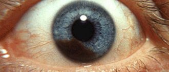 Choroidal melanoma of the eye