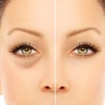 Eye mesotherapy: features of the procedure, indications and contraindications, reviews, photos