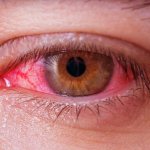 Is it possible to go to work with conjunctivitis?