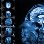 MRI of the brain for vasoneural conflict