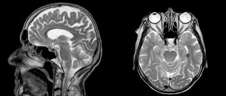 MRI head image