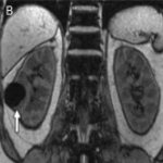 MRI of the retroperitoneum with contrast