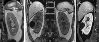 MRI of the retroperitoneum with contrast