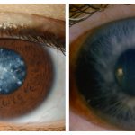 одновременное лечение глаукомы и катаракты