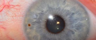 Scale in the eye